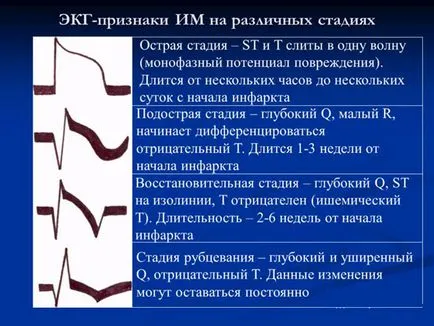Вогнищевий інфаркт міокарда - великий, причини, симптоми, лікування, дифузний (великий) Вогнищевий інфаркт міокарда - великий, причини, симптоми, лікування, дифузний