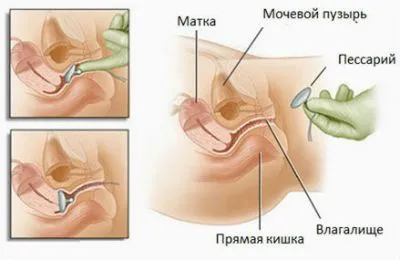 Опущення сечового міхура у жінок симптоми і лікування (сечового) Опущення сечового міхура у жінок симптоми і лікування