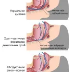 Зупинка дихання причини і ознаки (зупинка) Зупинка дихання причини і ознаки