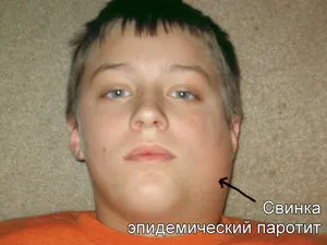 Основні характеристики епід або вірусного паротиту, його симптоми, ускладнення та методи лікування у (симптоми) Основні характеристики епід або вірусного паротиту, його симптоми, ускладнення та методи лікування у
