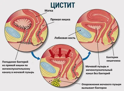 Відчуття повного сечового міхура основні причини (відчуття) Відчуття повного сечового міхура основні причини