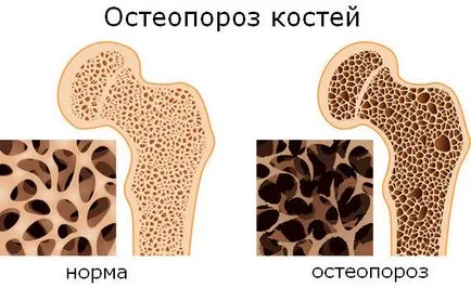 Остеопороз що потрібно робити для його запобігання (потрібно) Остеопороз що потрібно робити для його запобігання