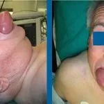 Набряк Квінке симптоми і лікування в домашніх умовах (набряк) Набряк Квінке симптоми і лікування в домашніх умовах