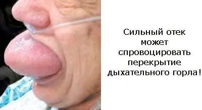 Набряк Квінке симптоми і лікування в домашніх умовах (симптоми) Набряк Квінке симптоми і лікування в домашніх умовах
