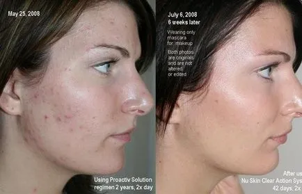 Відгуки про систему «proactiv» від прищів (proactiv) Відгуки про систему «proactiv» від прищів