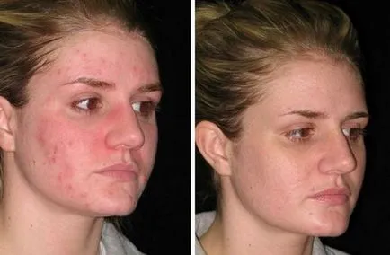 Відгуки про систему «proactiv» від прищів (системі) Відгуки про систему «proactiv» від прищів