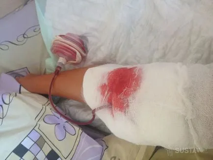 Відкачування рідини з колінного суглоба відкачка після артроскопії, ціни, боляче
