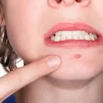 Папілома сечового міхура симптоми, лікування (симптоми) Папілома сечового міхура симптоми, лікування