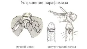 Парафімоз у дітей і дорослих - фото, причини, симптоми, лікування