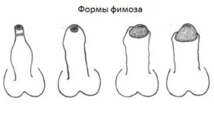 Парафімоз у дітей і дорослих - фото, причини, симптоми, лікування