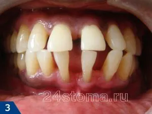 Пародонтит і пародонтоз в чому відмінність цих захворювань (пародонтоз) Пародонтит і пародонтоз в чому відмінність цих захворювань