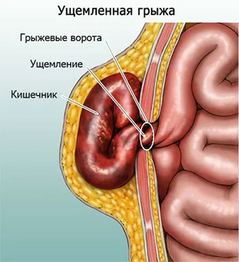 Пахово мошоночная грижа лікування у дітей та дорослих (лікування) Пахово мошоночная грижа лікування у дітей та дорослих