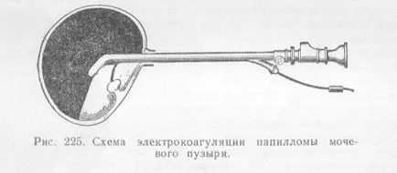 Папілома сечового міхура у чоловіків і жінок лікування, симптоми (жінок) Папілома сечового міхура у чоловіків і жінок лікування, симптоми