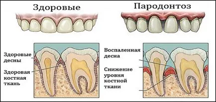 Пародонтоз ясен як лікують лікування в домашніх умовах (ясен) Пародонтоз ясен як лікують лікування в домашніх умовах