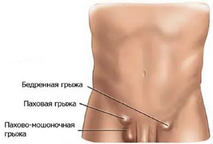 Пахово-мошоночная грижа у чоловіків причини і лікування (чоловіків) Пахово-мошоночная грижа у чоловіків причини і лікування