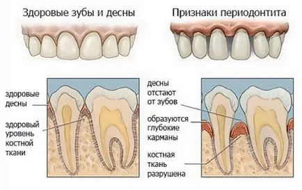 Періодонтит зуба гострий, хронічний причини розвитку, симптоми, діагностика, лікування періодонтиту