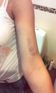 Чому з'являються синці на руках, перша допомога при ударах і гематомах (руках) Чому з'являються синці на руках, перша допомога при ударах і гематомах