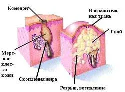 Чому виникають вугри