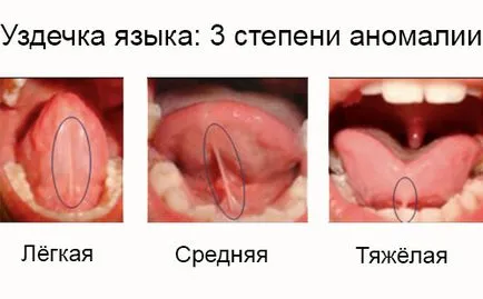 Підрізання вуздечки у дитини під язиком лазером або скальпелем - наслідки, відгуки (дитини) Підрізання вуздечки у дитини під язиком лазером або скальпелем - наслідки, відгуки