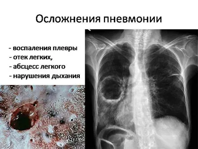 Двостороннє запалення легенів лікування та можливі ускладнення