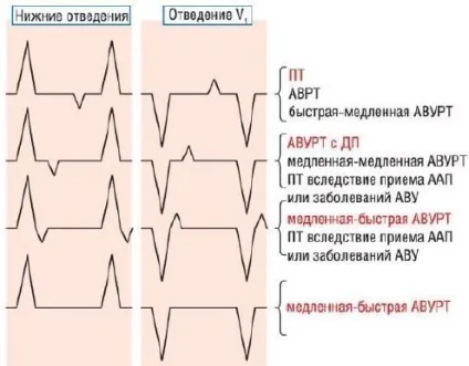 ЕКГ при передсердній тахікардії