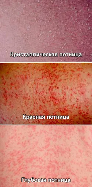 Пітниця в паху у чоловіків, жінок лікування, причини (паху) Пітниця в паху у чоловіків, жінок лікування, причини