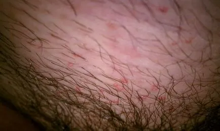 Пітниця в паху у чоловіків, жінок лікування, причини (чоловіків) Пітниця в паху у чоловіків, жінок лікування, причини