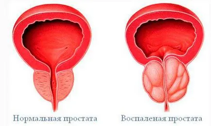 Останні досягнення в лікуванні раку простати сучасні методи