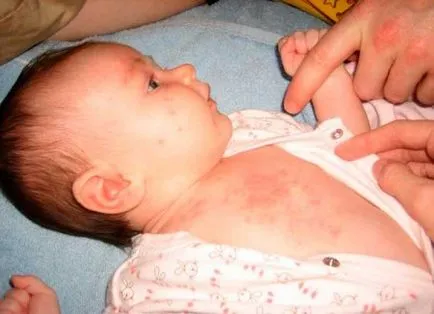Пітниця або алергія як відрізнити у дітей і у дорослих, фото