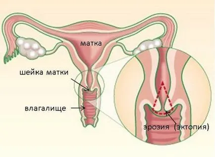 Після припікання ерозії кровит чи може кровить і як зупинити кровотечу (кровит) Після припікання ерозії кровит чи може кровить і як зупинити кровотечу