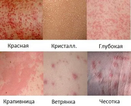 Пітниця або алергія як відрізнити у дітей і у дорослих, фото