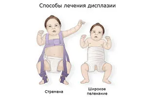 Правильне лікування дисплазії кульшового суглоба у дітей (дітей) Правильне лікування дисплазії кульшового суглоба у дітей