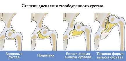 Правильне лікування дисплазії кульшового суглоба у дітей (лікування) Правильне лікування дисплазії кульшового суглоба у дітей