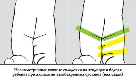 Правильне лікування дисплазії кульшового суглоба у дітей (дітей) Правильне лікування дисплазії кульшового суглоба у дітей