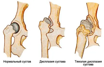 Правильне лікування дисплазії кульшового суглоба у дітей (тазостегнового) Правильне лікування дисплазії кульшового суглоба у дітей