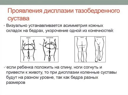 Правильне лікування дисплазії кульшового суглоба у дітей (лікування) Правильне лікування дисплазії кульшового суглоба у дітей