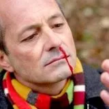 Припікання при носовій кровотечі - скальпель - медичний інформаційно-освітній портал (зупинити кровотечу носа) Припікання при носовій кровотечі - скальпель - медичний інформаційно-освітній портал