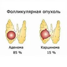 Ознаки та лікування захворювання щитовидної залози (проблеми зі щитовидною залозою симптоми у жінок) Ознаки та лікування захворювання щитовидної залози