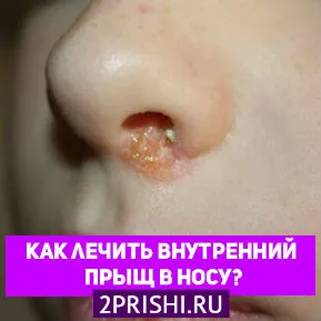 Прищ в носі внутрішній як лікувати що робити якщо гнійний прищ в носі дуже болить (внутрішній) Прищ в носі внутрішній як лікувати що робити якщо гнійний прищ в носі дуже болить