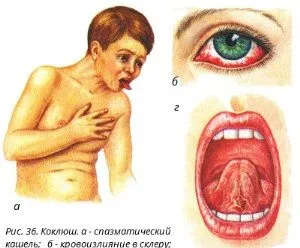 Щеплення від коклюшу потрібна, коли роблять, як переноситься, вакцини (вакцини) Щеплення від коклюшу потрібна, коли роблять, як переноситься, вакцини