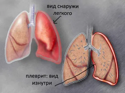 Причини та лікування болю в легенях зі спини (іррадіювати ліву руку) Причини та лікування болю в легенях зі спини