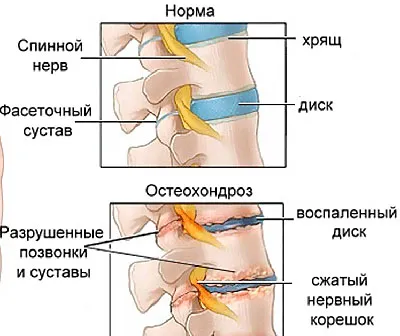 Причини та лікування болю в легенях зі спини (болить спина в області легких ззаду) Причини та лікування болю в легенях зі спини
