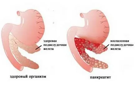 Ознаки, симптоми панкреатиту і його медикаментозне лікування, чи можна вилікувати повністю, гострий (панкреатиту) Ознаки, симптоми панкреатиту і його медикаментозне лікування, чи можна вилікувати повністю, гострий