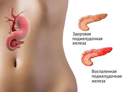 Ознаки, симптоми панкреатиту і його медикаментозне лікування, чи можна вилікувати повністю, гострий (симптоми) Ознаки, симптоми панкреатиту і його медикаментозне лікування, чи можна вилікувати повністю, гострий