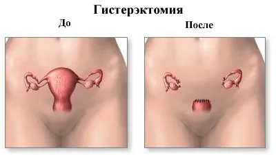 пролапс матки