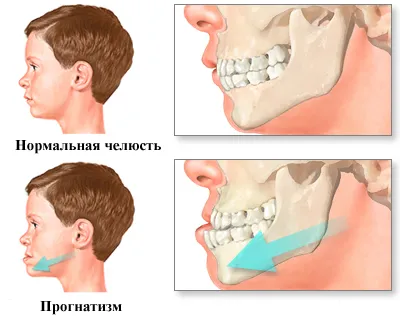 Прогнатизм - виступаючий вперед підборіддя