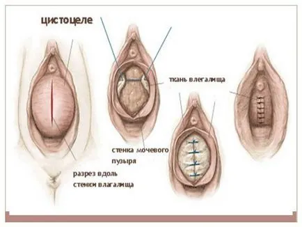 пролапс матки