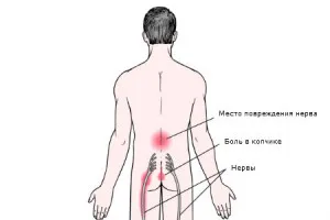 Радикуліт - причини, симптоми і народні засоби лікування радикуліту (кошти) Радикуліт - причини, симптоми і народні засоби лікування радикуліту