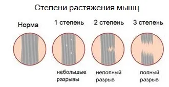 Розтягнення м'язів стегна симптоми і лікування (симптоми) Розтягнення м'язів стегна симптоми і лікування