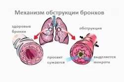 Рецидивуючий обструктивний бронхіт у дітей причини і лікування (дітей) Рецидивуючий обструктивний бронхіт у дітей причини і лікування